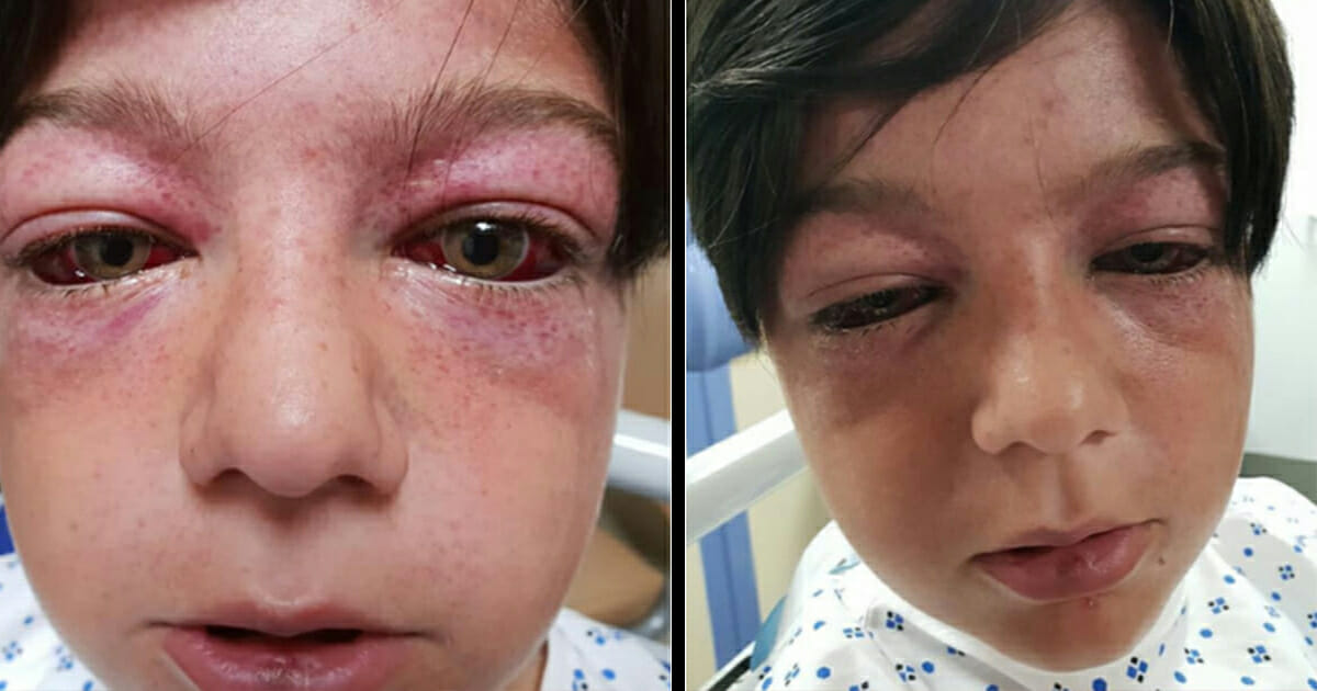 Mom wants to warn parents after her kid’s face is almost destroyed by a playground stunt