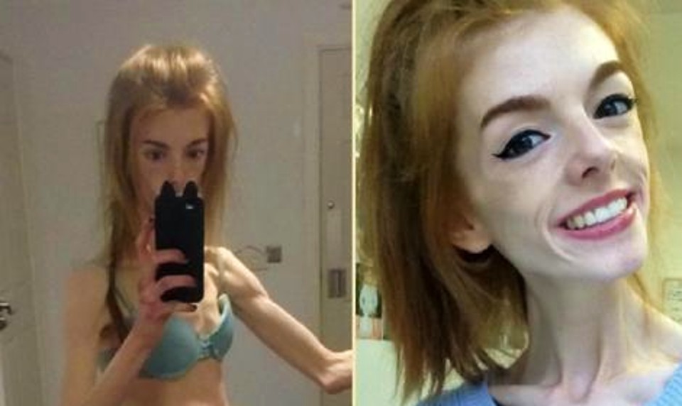 Look at her now that she’s won the battle with anorexia