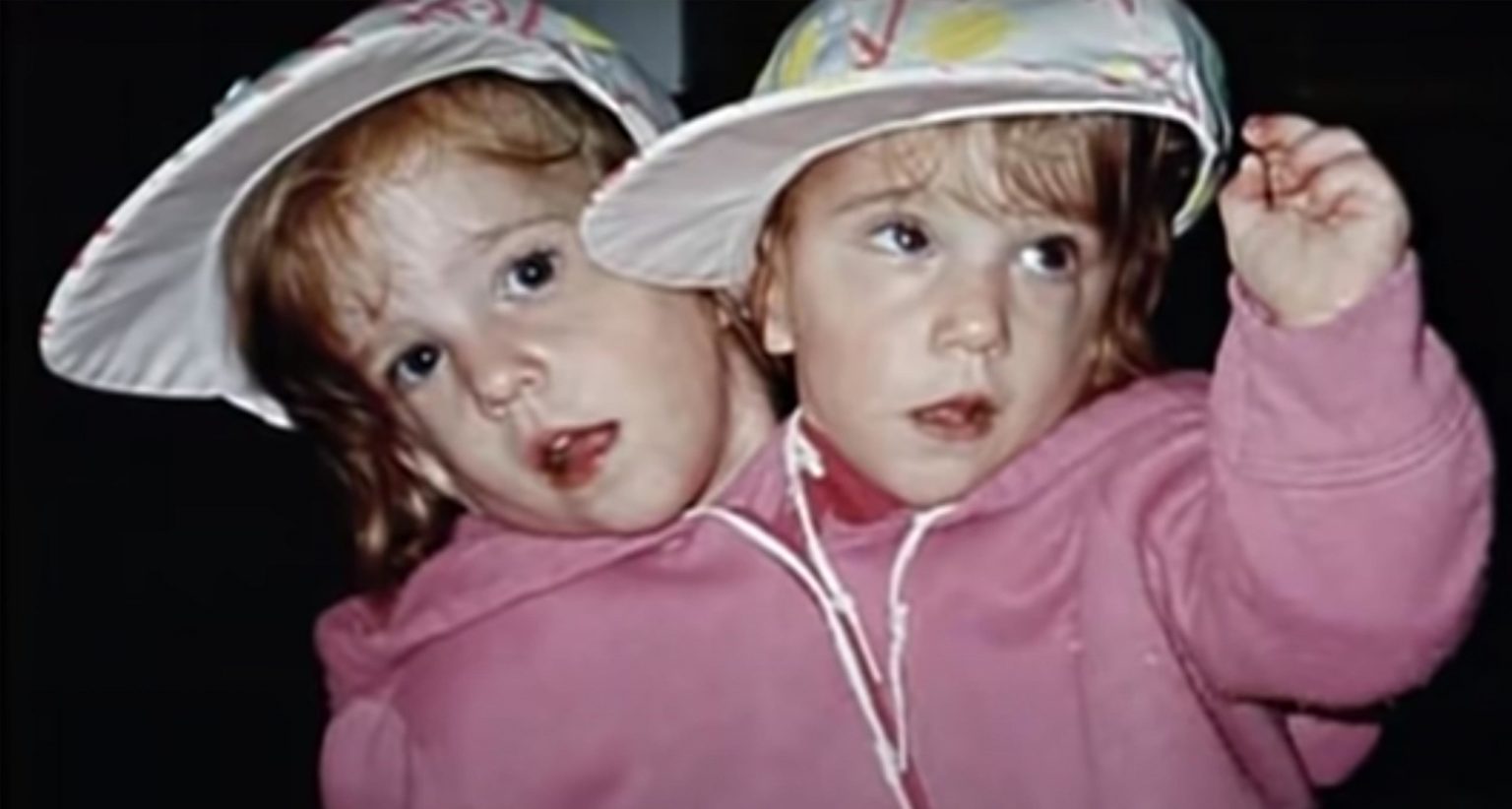 Abby and Brittany Hensel: The conjoined twins that reached worldwide ...