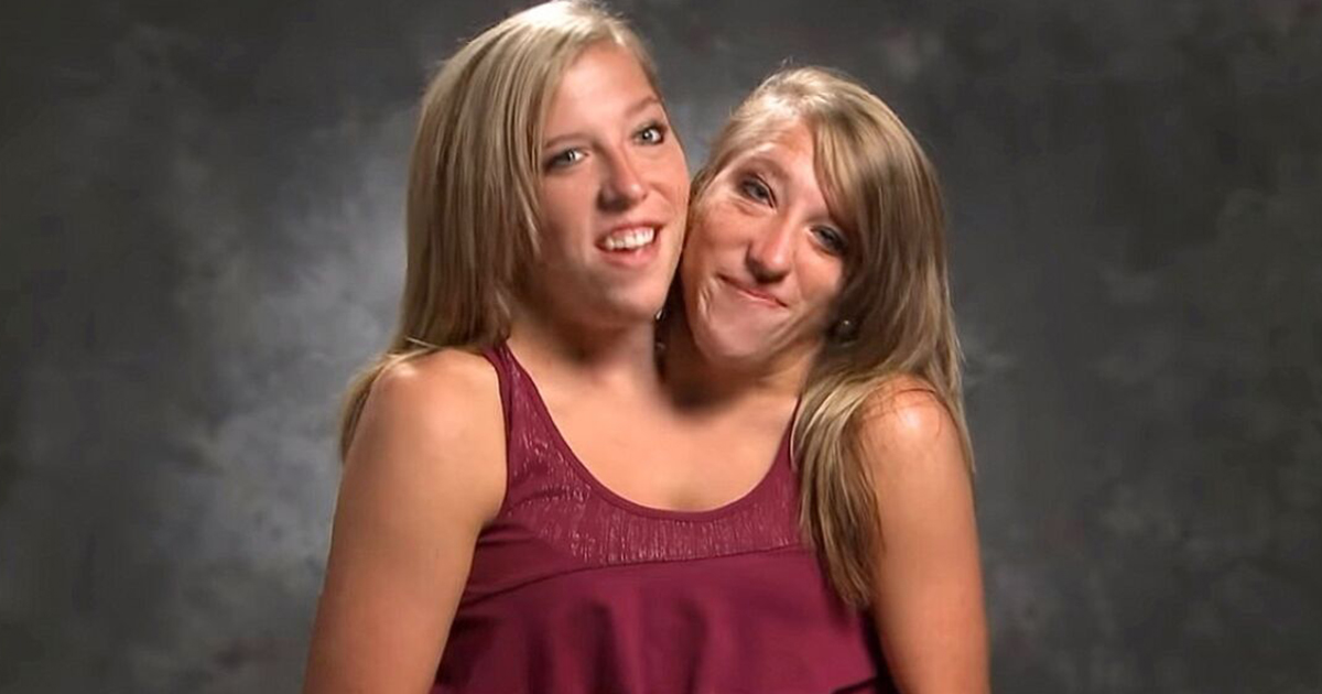 Abby and Brittany Hensel: The conjoined twins that reached worldwide fame
