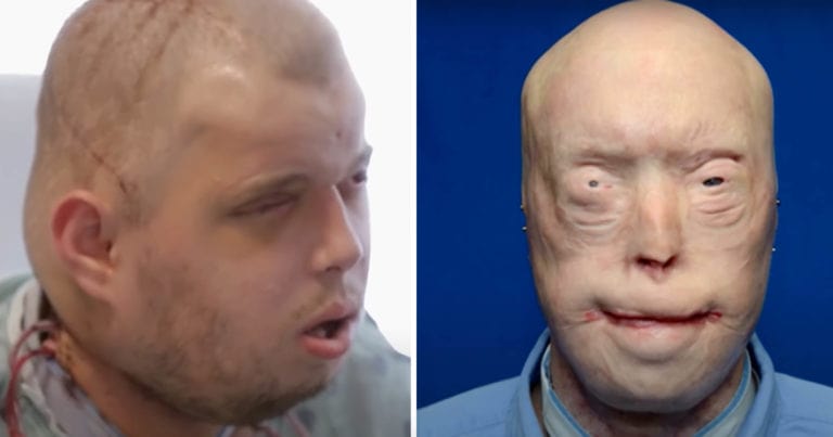 After third-degree burns, a firefighter receives a face transplant and survives against all chances — see him now, 7 years later