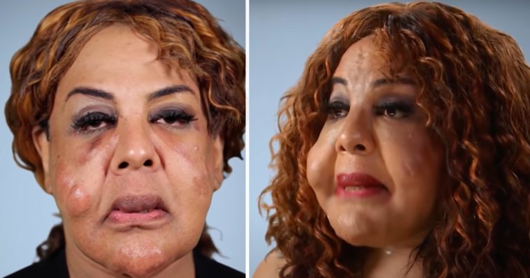 The “doctor” put cement in her face – that’s what she looks like after 14 years
