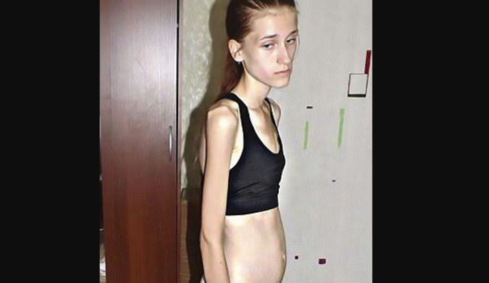 An 18-year-old girl with anorexia weights 70 pounds, demonstrating the power of motivation and perseverance.
