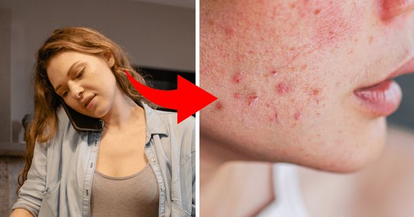 Understanding the Causes of Acne on Different Body Parts