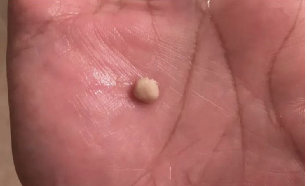 The Fascinating World of Tonsil Stones