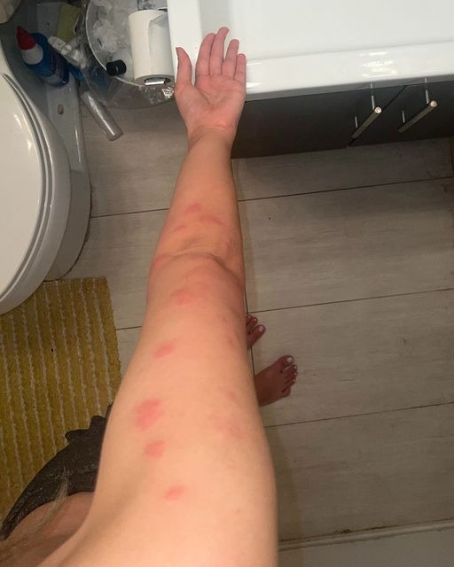 Identifying Common Bug Bites