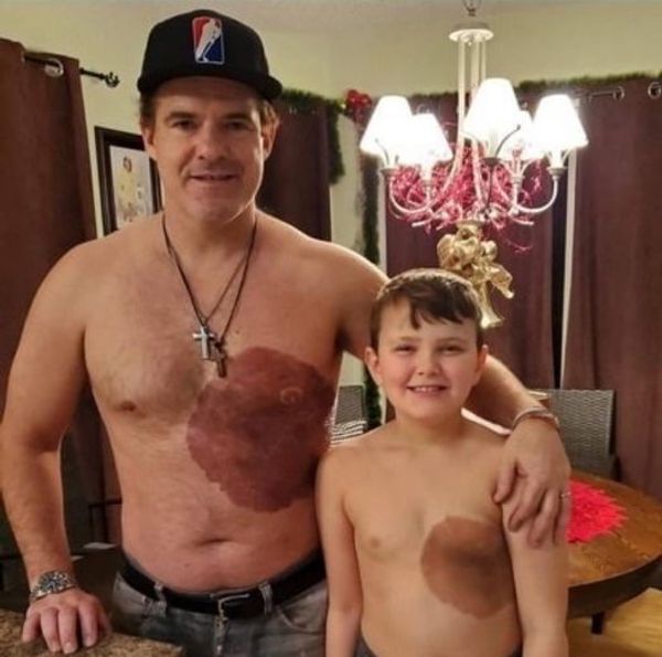 Dad Gets Matching Birthmark Tattoo